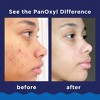 PanOyxl 2 Pack/5.5oz Maximum Strength Antimicrobial Acne Foaming Wash for Face, Chest and Back with 10% Benzoyl Peroxide - Unscented - 4 of 4