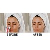 LINSAY Microdermabrasion and Blackhead remover Pro At-Home Facial Device 5 in 1 - 2 of 4