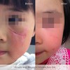RejuvaSil Silicone Scar Gel - 3 of 4