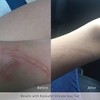 RejuvaSil Silicone Scar Gel - 4 of 4