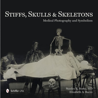 Stiffs, Skulls & Skeletons - by  Stanley B Burns & Elizabeth a Burns (Hardcover)