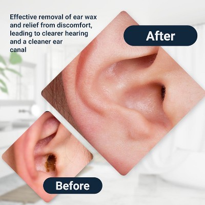 Doctor Easy Rhino Ear Washer System - Thumbnail 5
