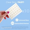 MEDca Hydrocolloid Acne Patches for Face – 360-Count Pimple Spot Bandages in 2 Sizes for Acne, Zits & Blackheads - 2 of 4
