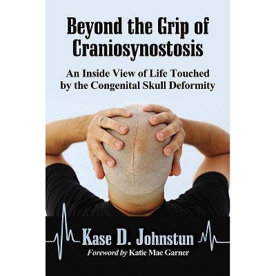 Beyond the Grip of Craniosynostosis - by  Kase D Johnstun (Paperback)