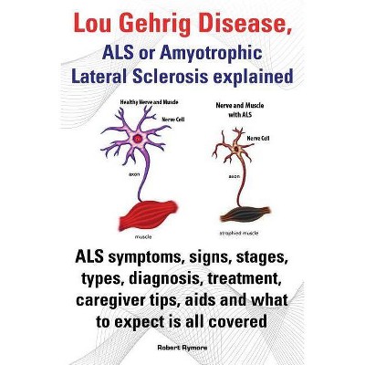 Lou Gehrig Disease, ALS or Amyotrophic Lateral Sclerosis Explained. ALS Symptoms, Signs, Stages, Types, Diagnosis, Treatment, Caregiver Tips, AIDS