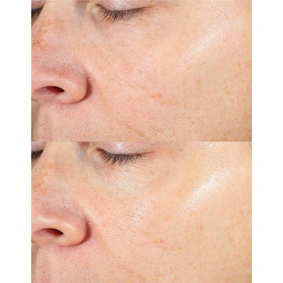 Vitamin C 10% Multi-Acid Radiance Liquid Peel for Dry Skin