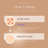 Project E Beauty LumaGlow Blue Light Therapy For Acne | Acne Light Therapy For Face | Blue Light Acne Treatment Device | Spot Scars Remove | Facial - 3 of 4