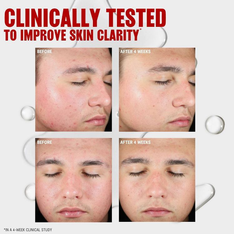 Thayers Natural Remedies Clearing Toner With Salicylic Acid - 12 fl oz, 6 of 9