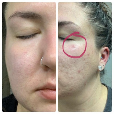 dr pimple popper target