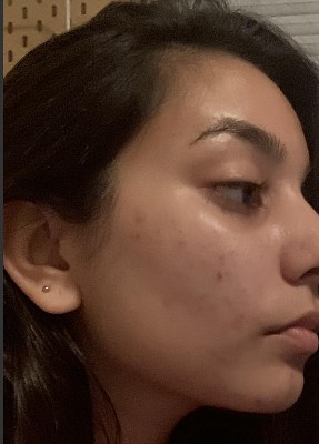 versed overnight peel reviews