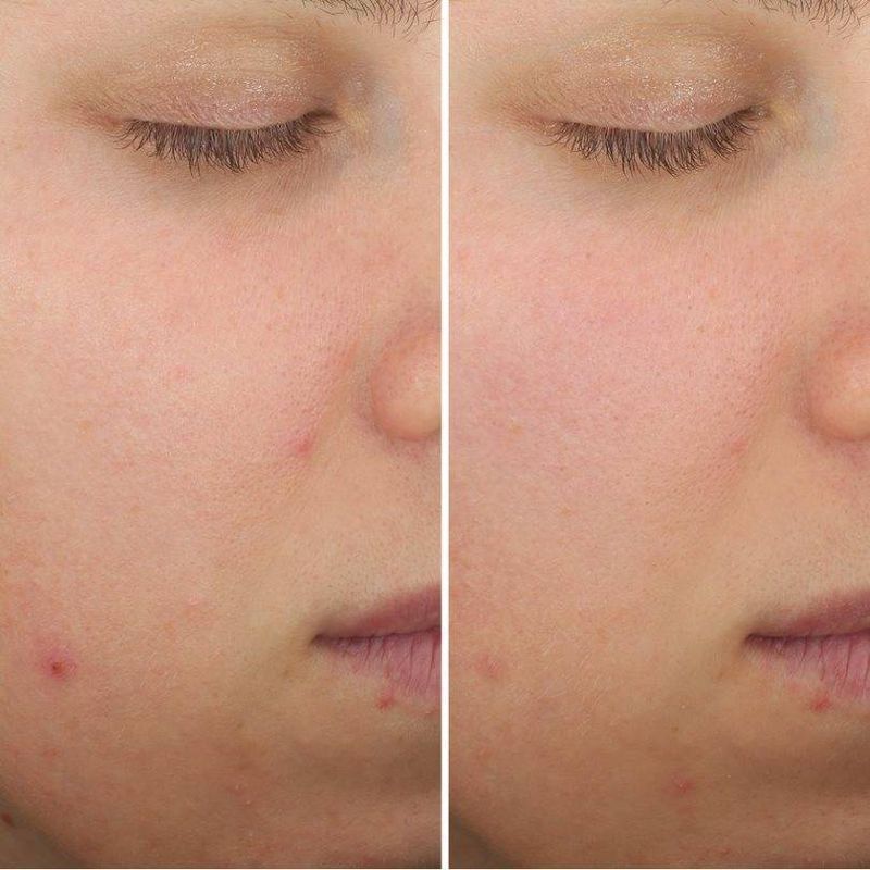 IT Cosmetics Bye Bye Breakout Facial Treatment - 0.85oz - Ulta Beauty, 5 of 7