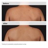 The Ordinary Salicylic Acid 0.5% Body Serum Exfoliating Treatment for Acne Blemishes- 8.11 fl oz - Ulta Beauty - 3 of 4