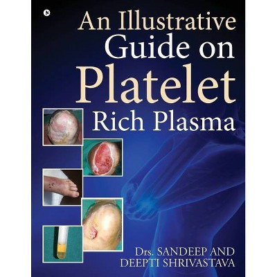 An Illustrative Guide on Platelet Rich Plasma - by  Dr Sandeep & Dr Deepti Shrivastava (Paperback)