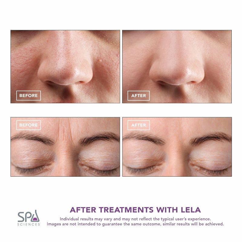 Spa Sciences LELA Ultrasonic Facial Spatula System, 6 of 15