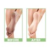 Be Natural by Prolinc Dry Heel Eliminator | Protect and Hydrates Dry Heels and Feet | Pro Linc Ideal for Dry Cracked Feet - (16 oz) - 4 of 4