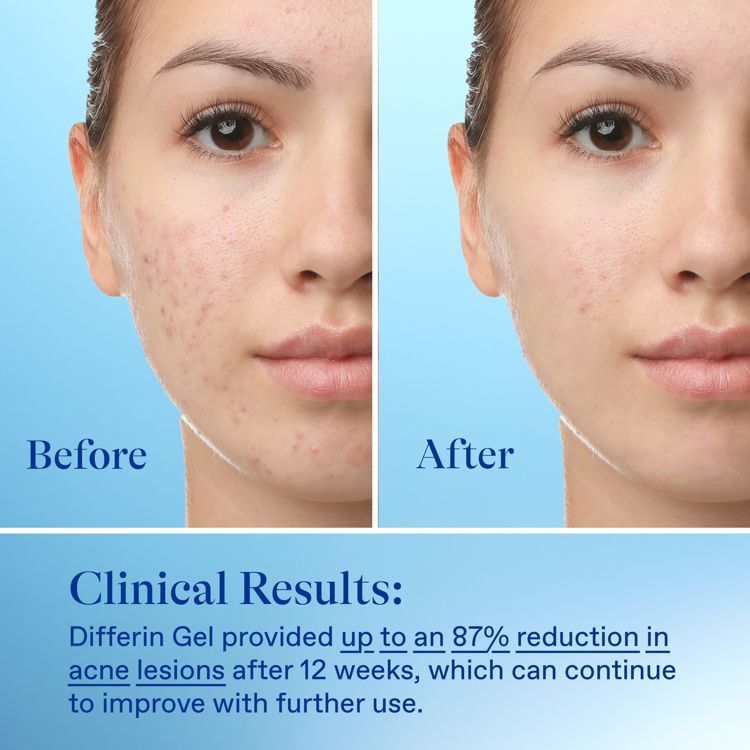 Differin Acne Retinoid Treatment Gel Adapalene 0.1%, 6 of 8