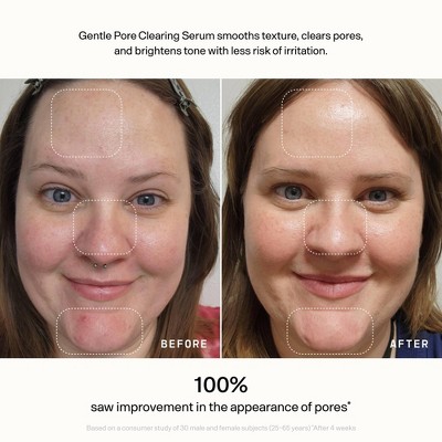 Versed Skin Refine Gentle Pore Clearing Serum - 1 fl oz: Vegan, Salicylic Acid, Paraben-Free, For Normal & Oily Skin