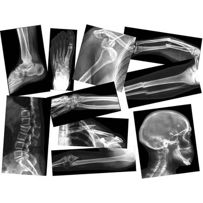 Roylco Broken Bones X-Rays