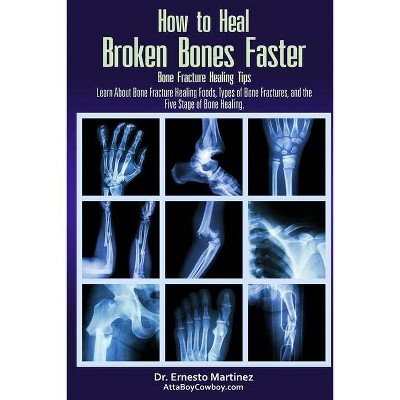 How to Heal Broken Bones Faster. Bone Fracture Healing Tips - (Health and Wellness) by  Ernesto Martinez (Paperback)