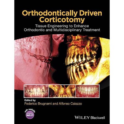 Orthodontically Driven Corticotomy - by  Federico Brugnami & Alfonso Caiazzo (Hardcover)