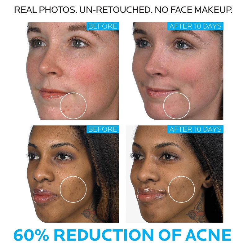 La Roche Posay Effaclar Duo Acne Treatment with Benzoyl Peroxide, Dual Action Acne Spot Treatment - 1.35 fl oz​, 5 of 12