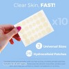 MEDca Hydrocolloid Acne Absorbing Covers – 240-Count Pimple Spot Bandages in 3 Sizes for Acne, Zits & Blackheads - 2 of 4