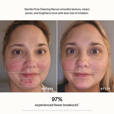 Versed Skin Refine Gentle Pore Clearing Serum - 1 fl oz: Vegan, Salicylic Acid, Paraben-Free, For Normal & Oily Skin
