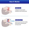 YEVYO Anti-Snoring Mouthpiece - Mouth Guard Device with +2mm Jaw Adjustment, Breathable Anti Snoring Solution for Men & Women - Includes Case - Blue - 3 of 4
