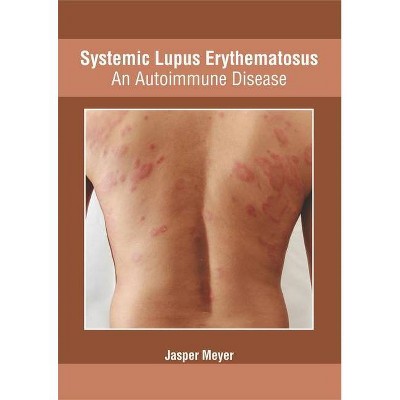 Systemic Lupus Erythematosus: An Autoimmune Disease - by  Jasper Meyer (Hardcover)