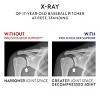 OPTP PRO Shoulder Support - 4 of 4