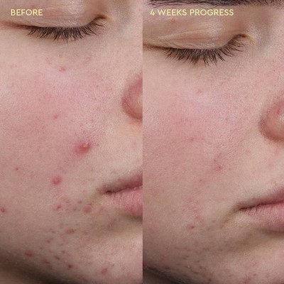 BYOMA Blemish Acne Clearing Creamy Cleanser - 5.91 fl oz: Paraben-Free, Facial Treatments, Lotion, Fresh Scent
