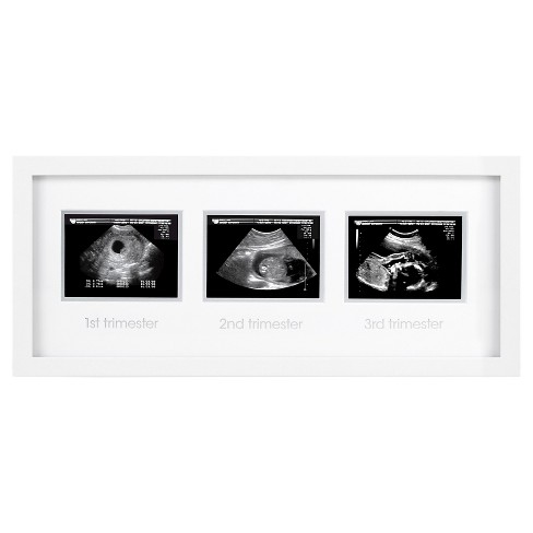  Ultrasound Picture Frame