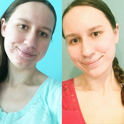 nxn acne edit cleanser