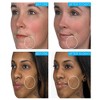 La Roche-Posay Effaclar Duo Acne Treatment with Benzoyl Peroxide, Dual Action Acne Spot Treatment - 1.35 fl oz​ - image 2 of 4