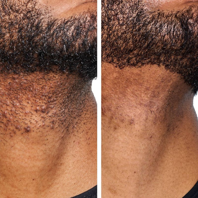 Urban Skin Rx Men&#39;s Daily Exfoliating Face Wash + Scrub - 5.1 fl oz, 4 of 7