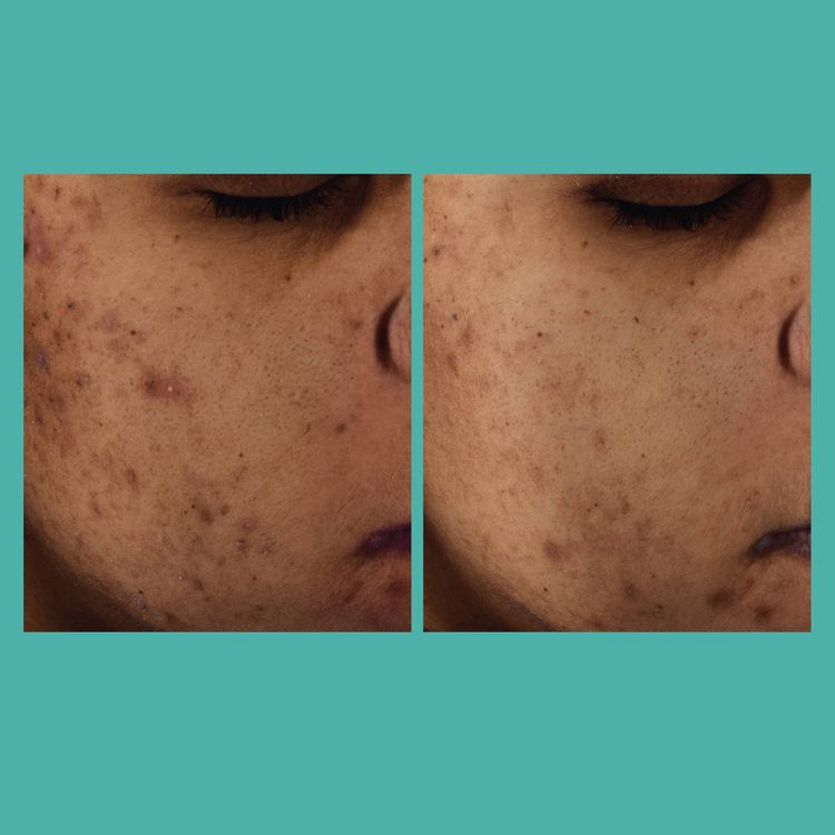 L'Oreal Paris Bright Reveal 12% Niacinamide Dark Spot Serum - 1 floz, 5 of 11