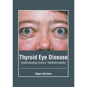 Thyroid Eye Disease: Understanding Graves' Ophthalmopathy - by  Edgar Harrison (Hardcover) - 1 of 1