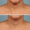 StriVectin TL Advanced Tightening Neck Cream Plus - 1oz - Ulta Beauty - image 3 of 4