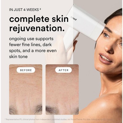 Nood The Flasher Pro Laser Hair Removal Kit