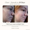 Faisca Neon & Argon High Frequency Wand by Project E Beauty | Anti-Aging & Anti-Acne | Wrinkles Removal | Hair Growth | Minimize Pores | Wound Healing - 3 of 4