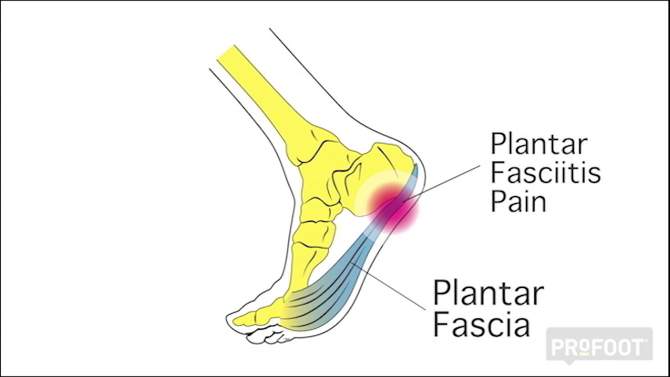 PROFOOT Fasciitis Orthotic - Women, 2 of 6, play video