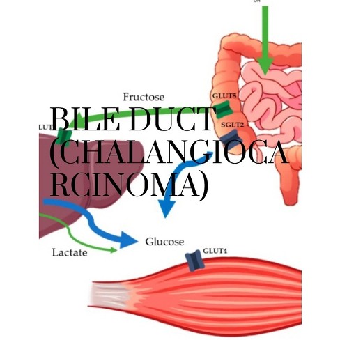 bile duct cancer