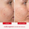 FIRST AID BEAUTY Daily Acne Clearing Pads with 2% Salicylic Acid - 60ct - Ulta Beauty - 3 of 4