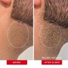 FIRST AID BEAUTY Ingrown Hair Pads, Pre-Shave Gentle Exfoliating Body Pads for Ingrown Hair Prevention - Ulta Beauty - 4 of 4