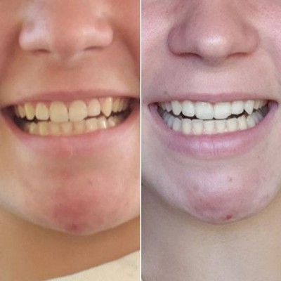 crest teeth whitening strips before and after