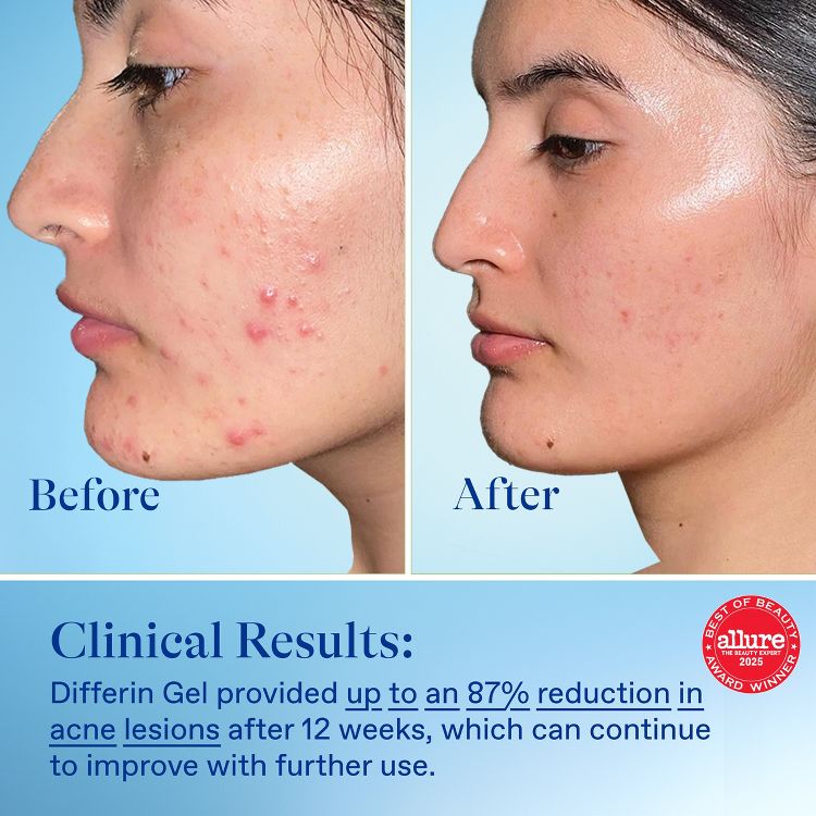 Differin Acne Retinoid Treatment Gel Adapalene 0.1%, 5 of 8