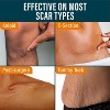 Nuvadermis Silicone Medical Grade Reusable Scar Tape - Clear - 60" Roll - 4 of 4