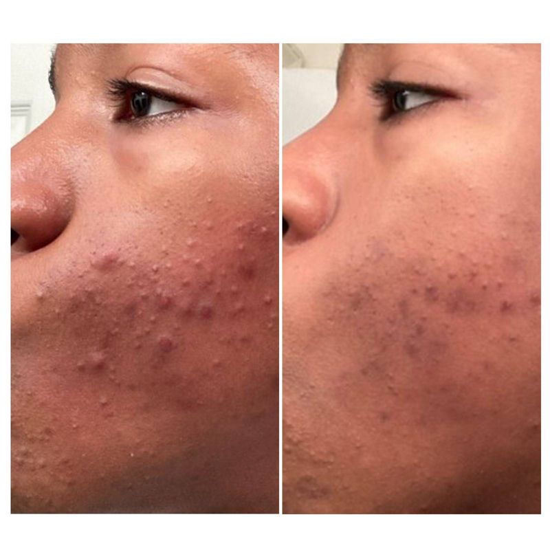 Urban Skin Rx Clear Complexion Acne Serum and Spot Treatment - 1 fl oz, 6 of 7